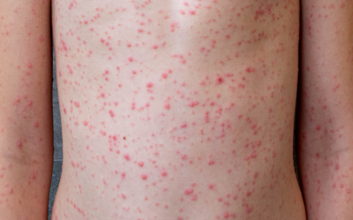 Lo que no se debe hacer cuando se tiene varicela