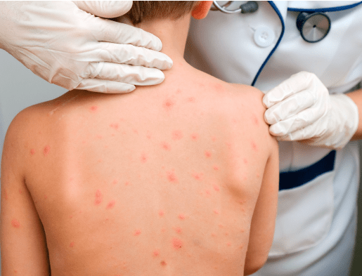 Los CDC de Estados Unidos y la Sociedad Latinoamericana de Infectología Pediátrica (SLIPE) recomiendan que los niños reciban dos dosis, cada una en las siguientes edades:1,2